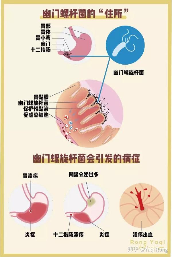 如果胃酸长期被幽门螺杆菌中和,胃酸也无法持续长期的过量分泌,胃部的