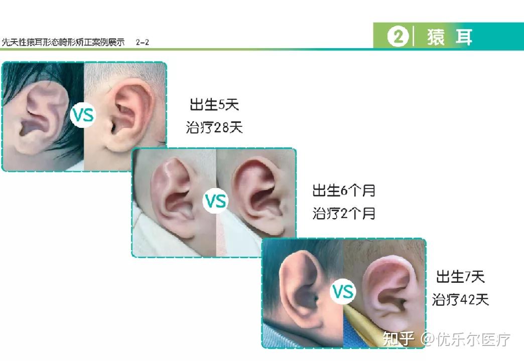 先天性新生兒耳廓畸形家長們一定要重視! - 知乎