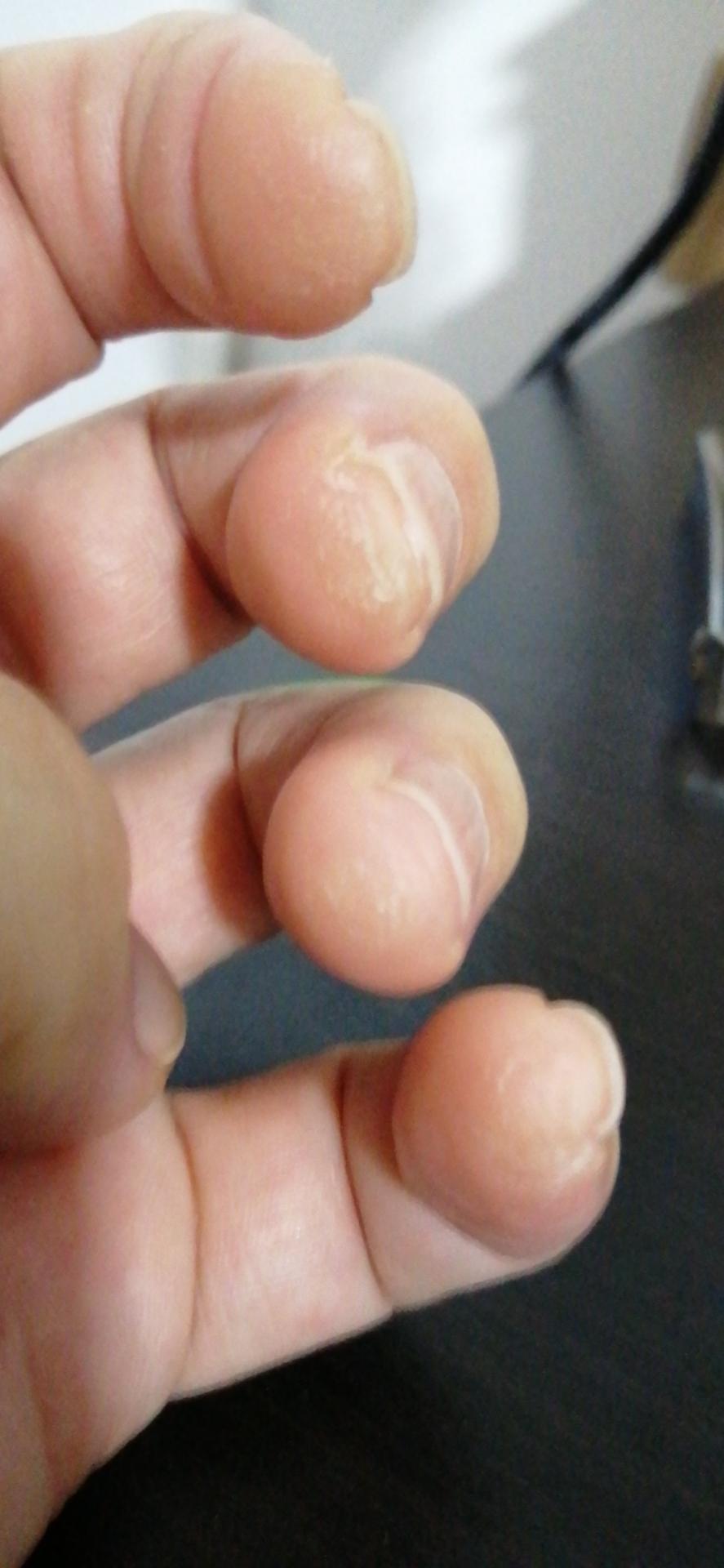 练吉他的时候左手按弦手指尖疼而且爆皮了怎么办