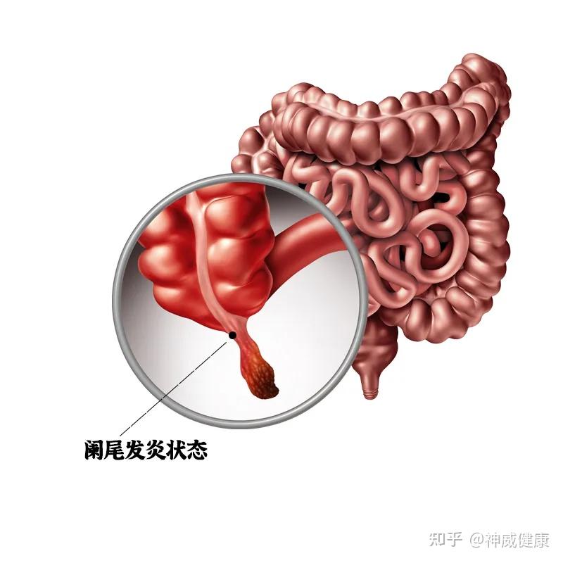 最常被误诊的病5岁女童差点拖到肚子烂