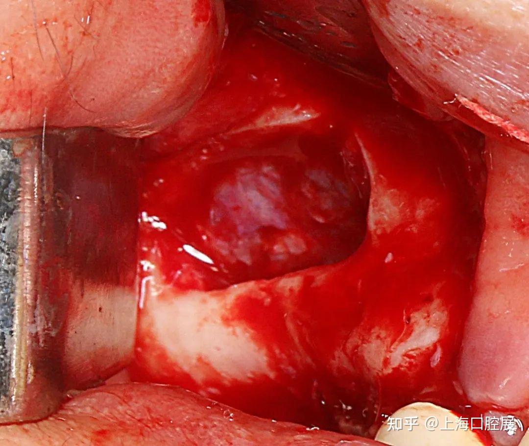 经典手术,值得收藏:一步一步指导如何超声骨刀进行上颌窦外提升术