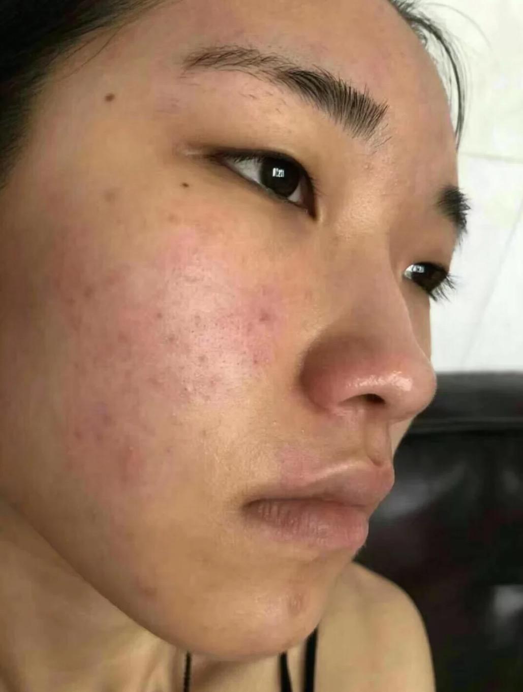 刷酸有用!不过刷错会烂脸,会爆皮爆痘过敏.