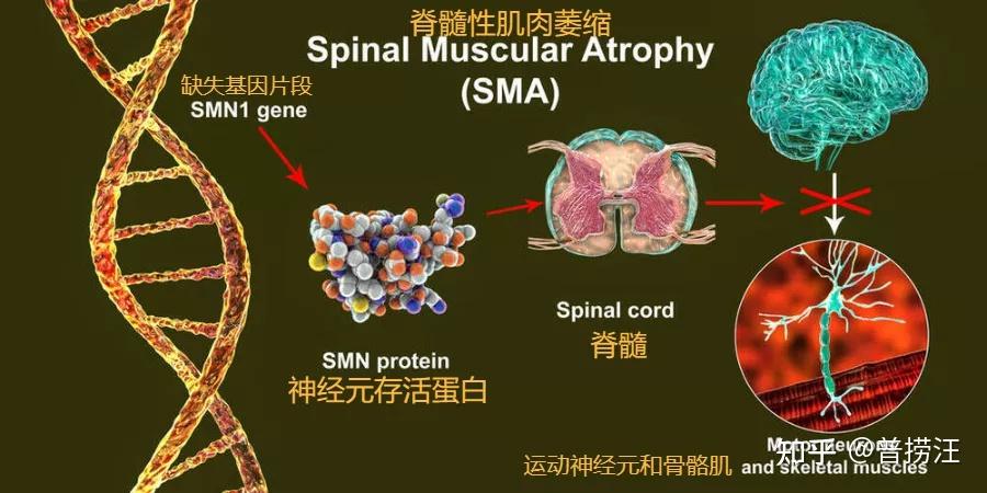 研究发现,脊髓性肌萎缩症是由于染色体中某段基因缺失或异常(smn1)