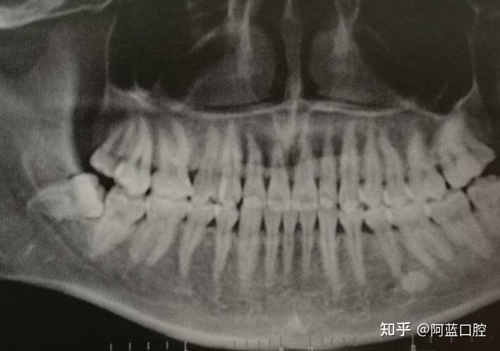 什么是智齿冠周炎？为什么发炎时不能拔牙？ - 知乎