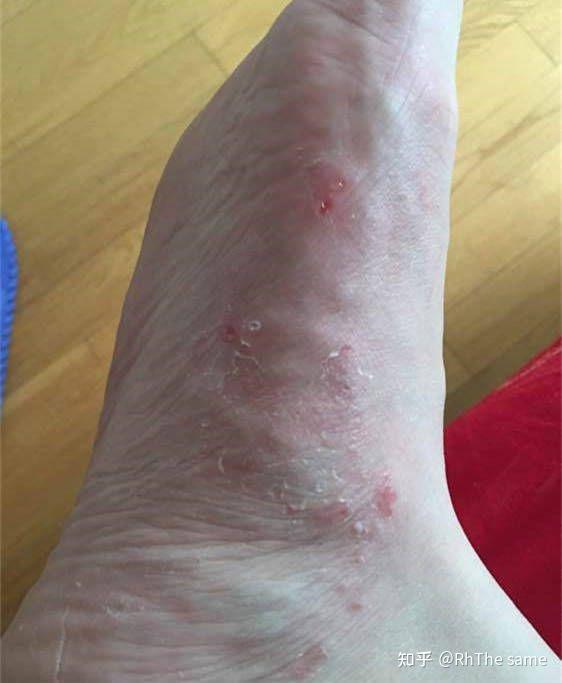 脚臭怎么办试试这个简单小方法管用