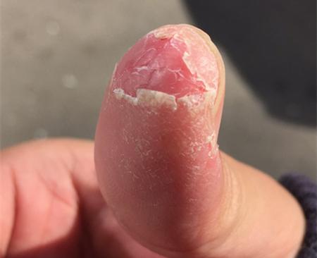 手蜕皮发干裂开了口子剥脱性角质疏松症
