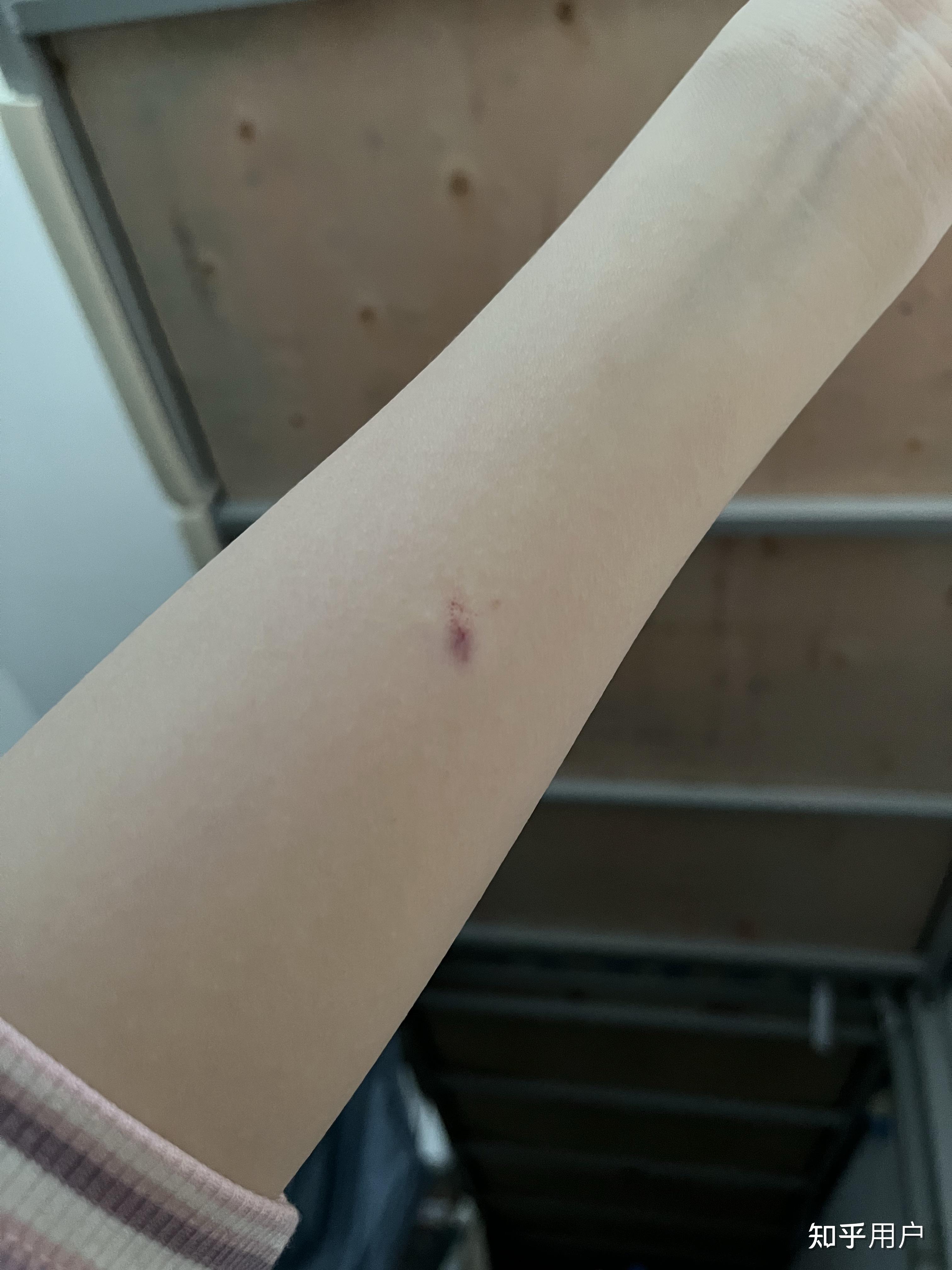 ppd皮试后这个样子怎么办 知乎
