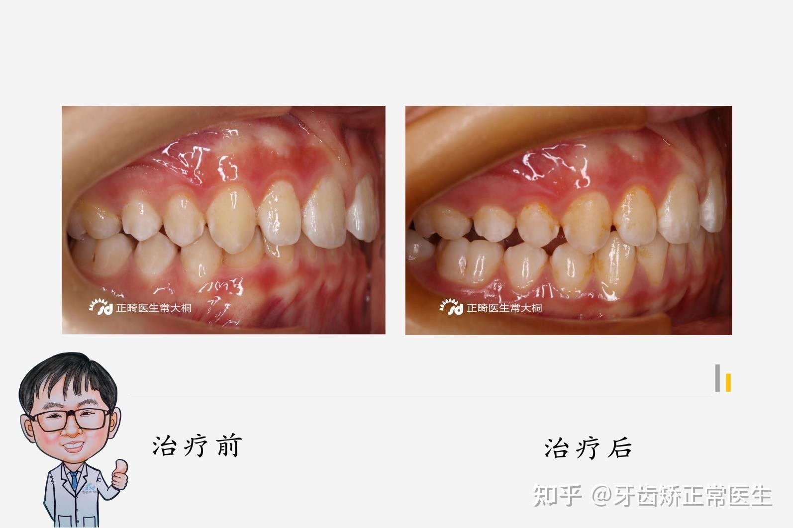 鄭州牙齒矯正常大桐平導twinblock早期矯治深覆合