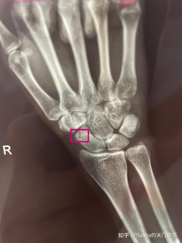 右手手腕舟骨骨折恢复过程 知乎 右手手腕舟骨骨折恢复过程 知乎