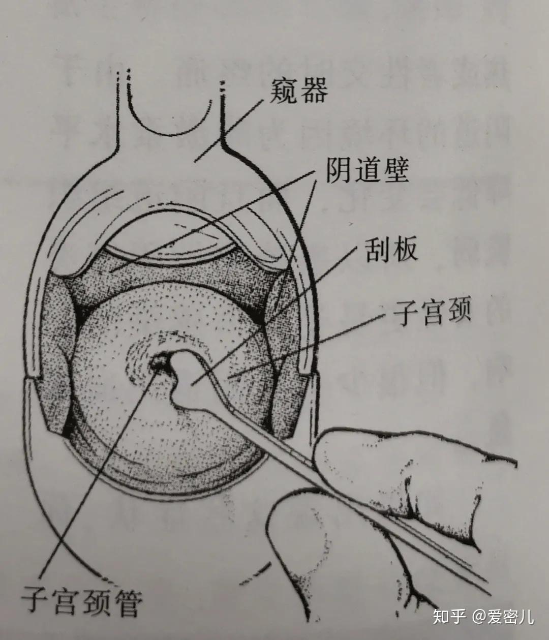 爱密儿全球首次承诺消除一种癌症宫颈癌