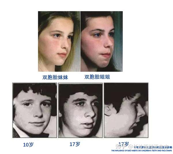儿童错颌畸形的危害以及早期干预 - 知乎