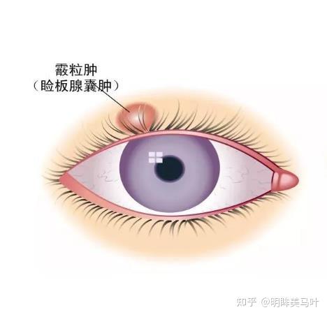 睑板腺囊肿详解:成因,治疗方法及预防策略