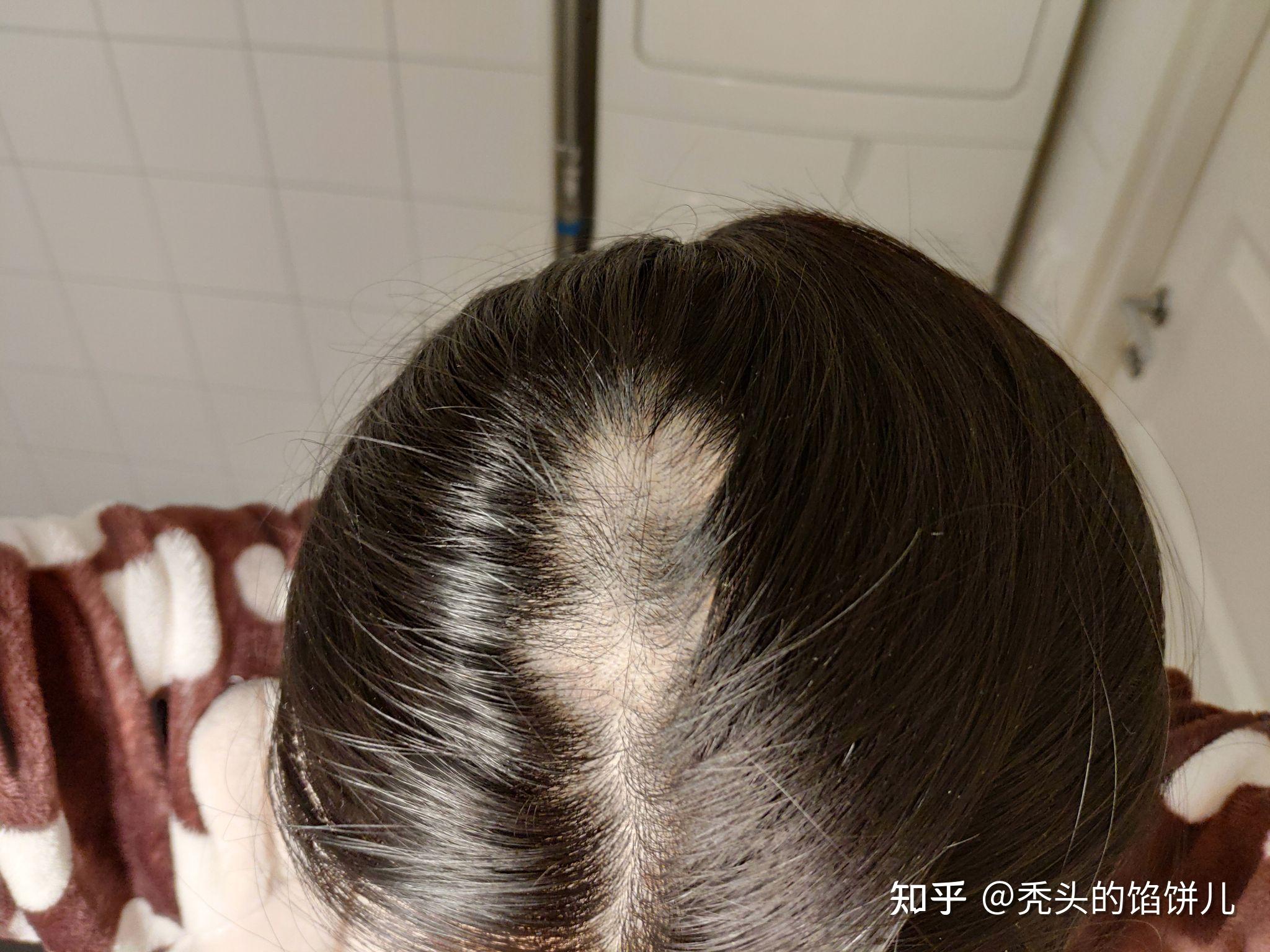 记录雄激素脱发在广州的治疗经历--广东省皮肤病医院(南方医科大学皮肤病医院) - 知乎