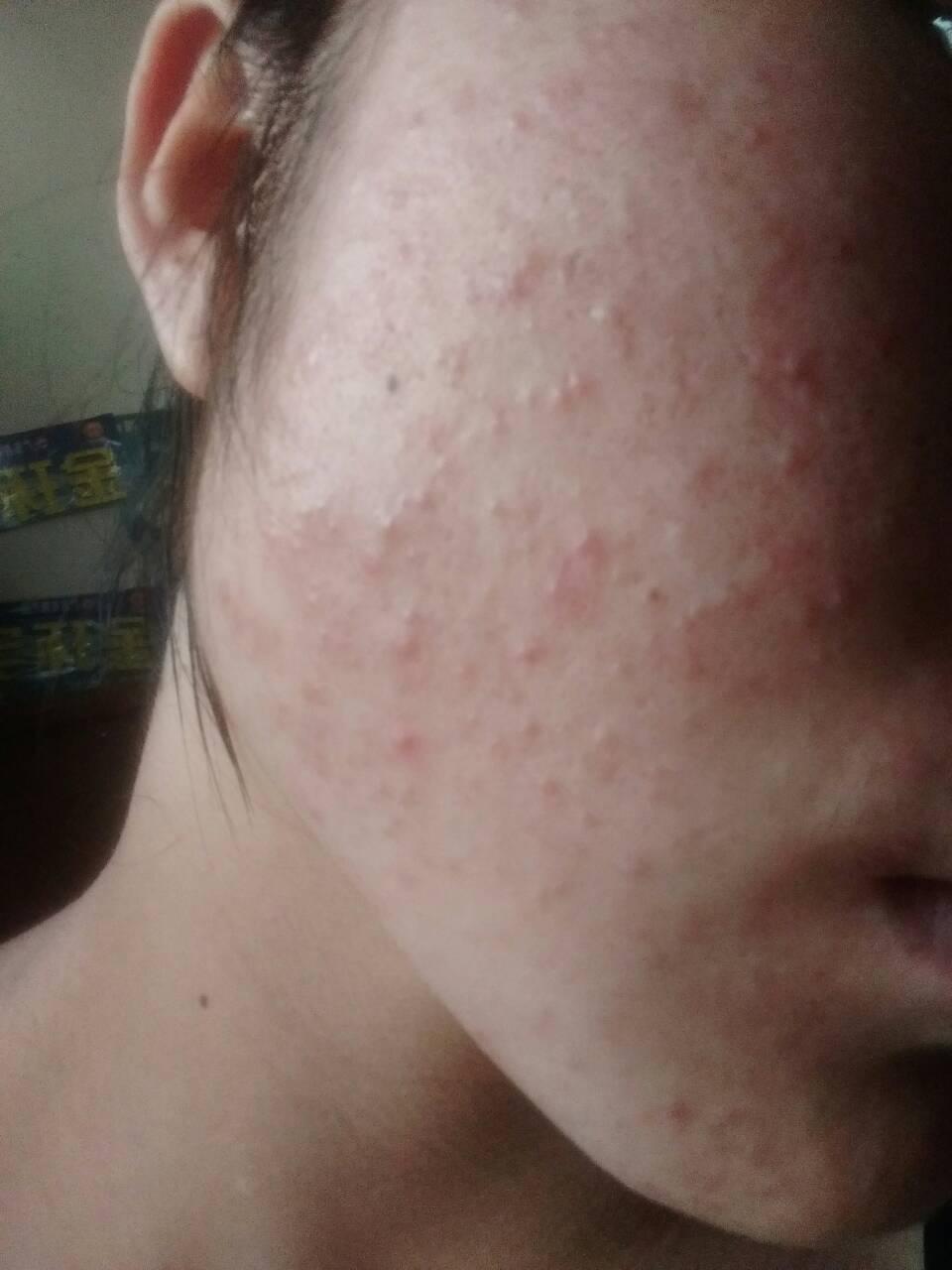 脸上总是反反复复张白头粉刺 而且红红的 真的很心病该怎么办?