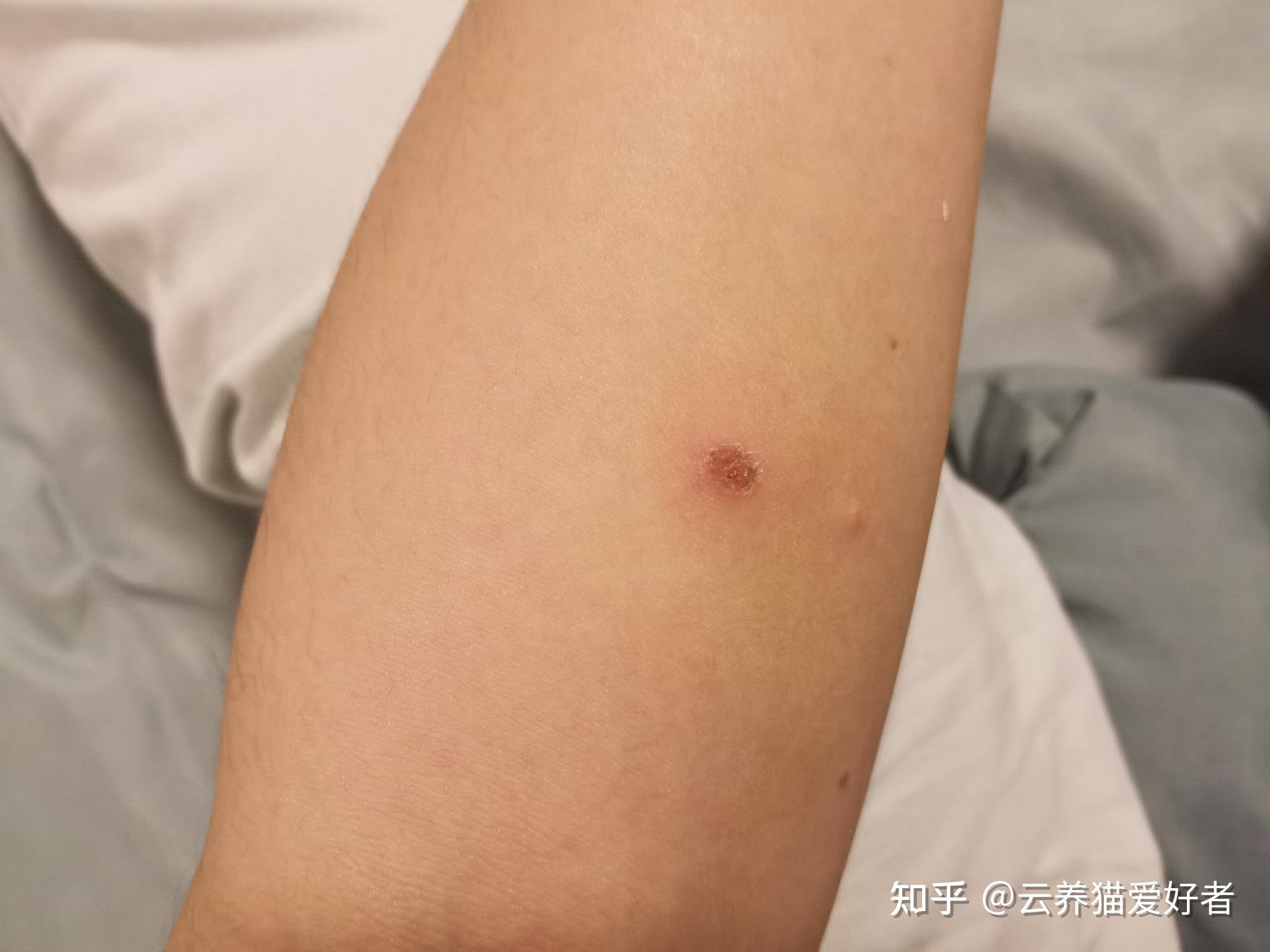 你们在生活中被猫抓伤以后伤口都有什么特点啊是不是出血以后都会红肿