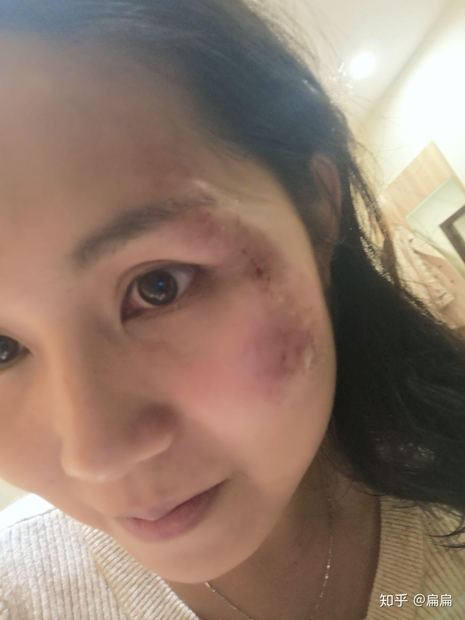 但是红黑的一片,怎样才能避免留疤? - 知乎