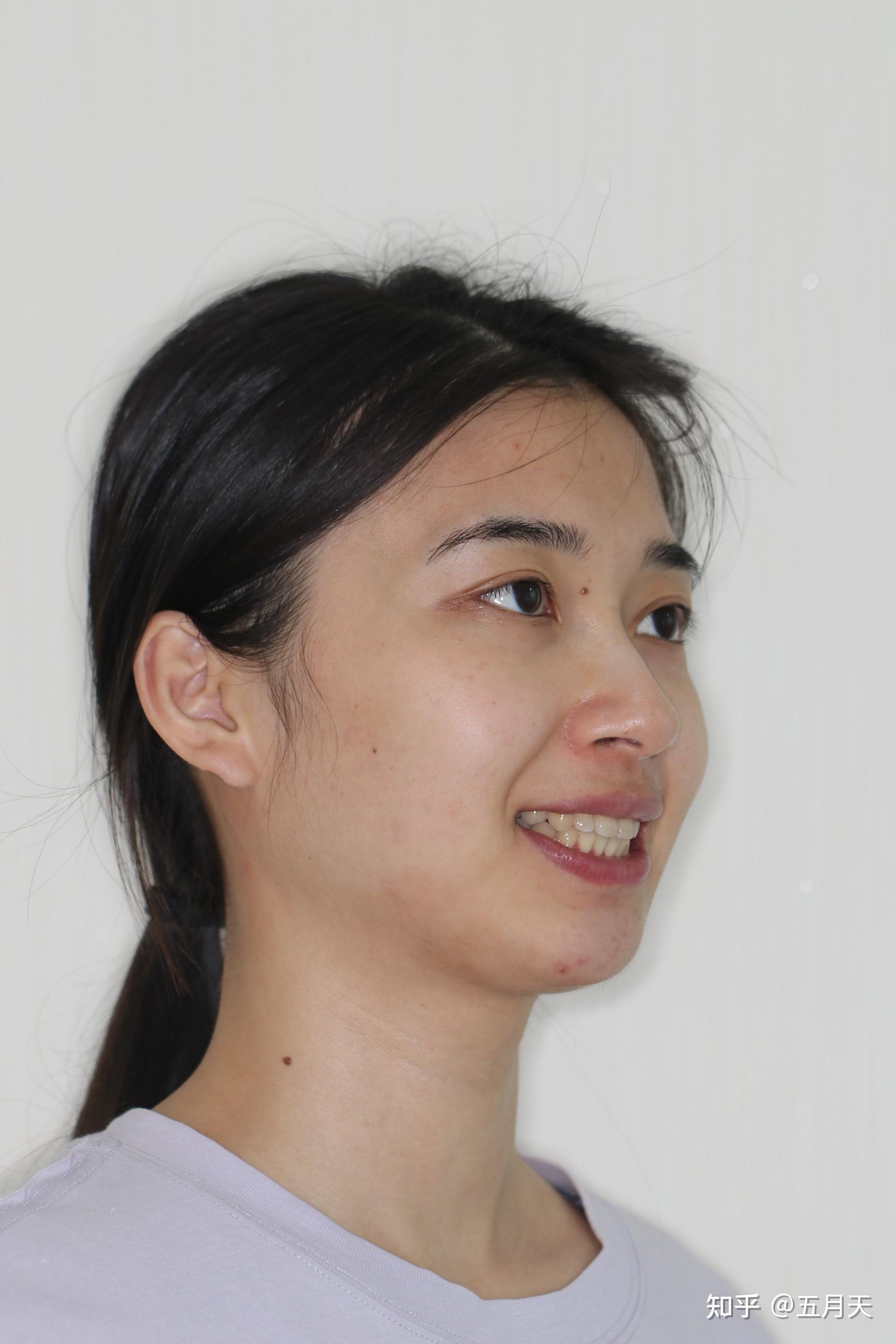 一个牙套真的改变了我那么多姐妹们牙齿矫正真的是太香了