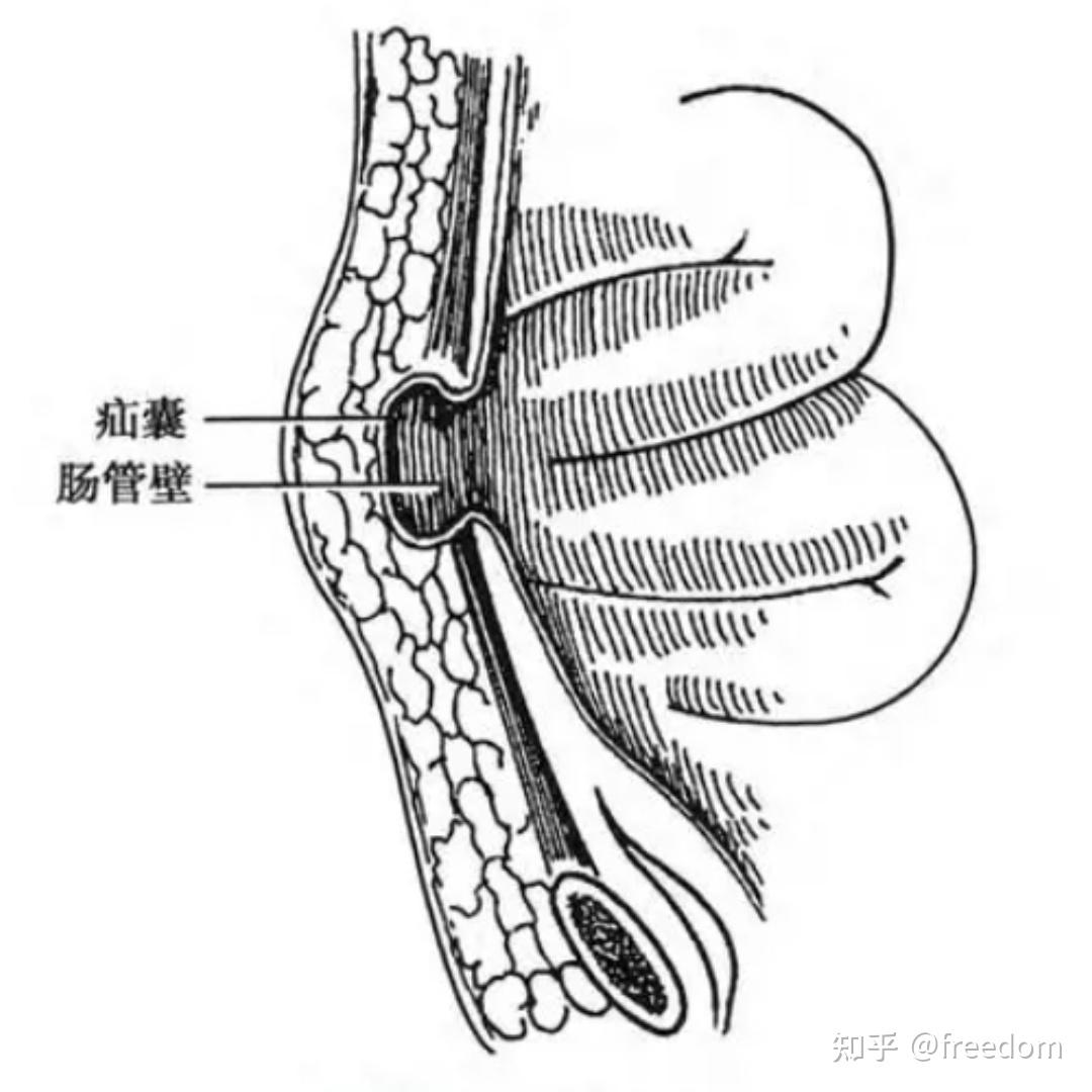疝气有哪些常见的类型?