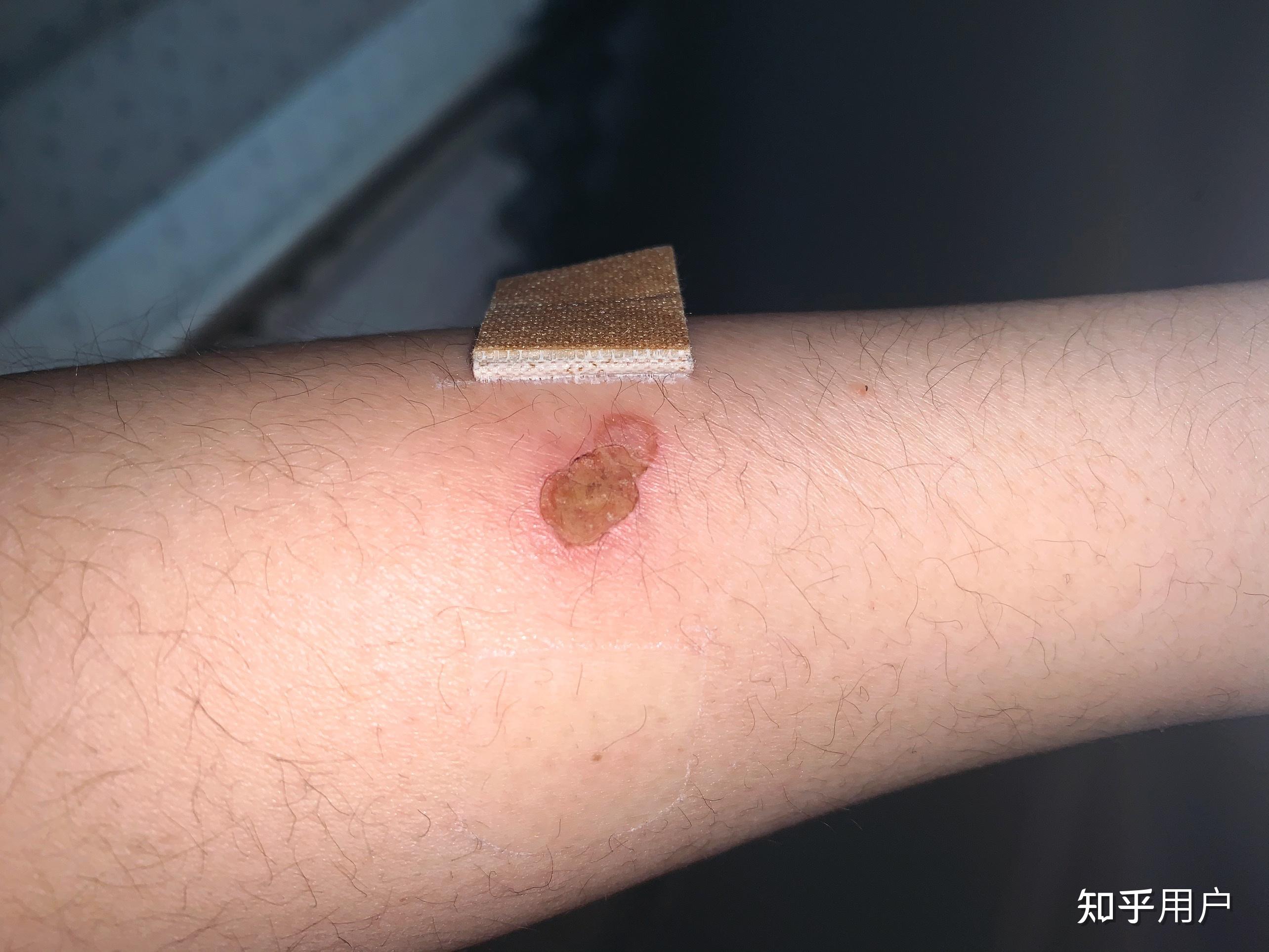 为什么有人会往身上烫烟疤? - 知乎