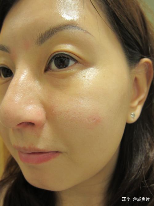 身体肤色正常但脸部黑红怎么解决