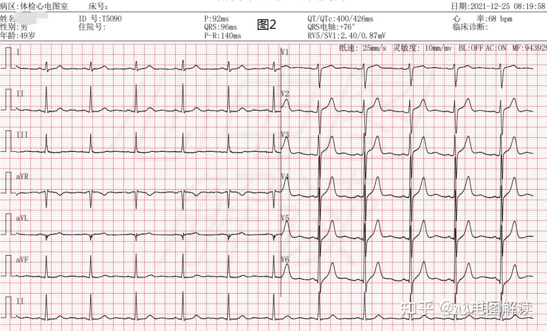 心梗?左右手互换? - 知乎