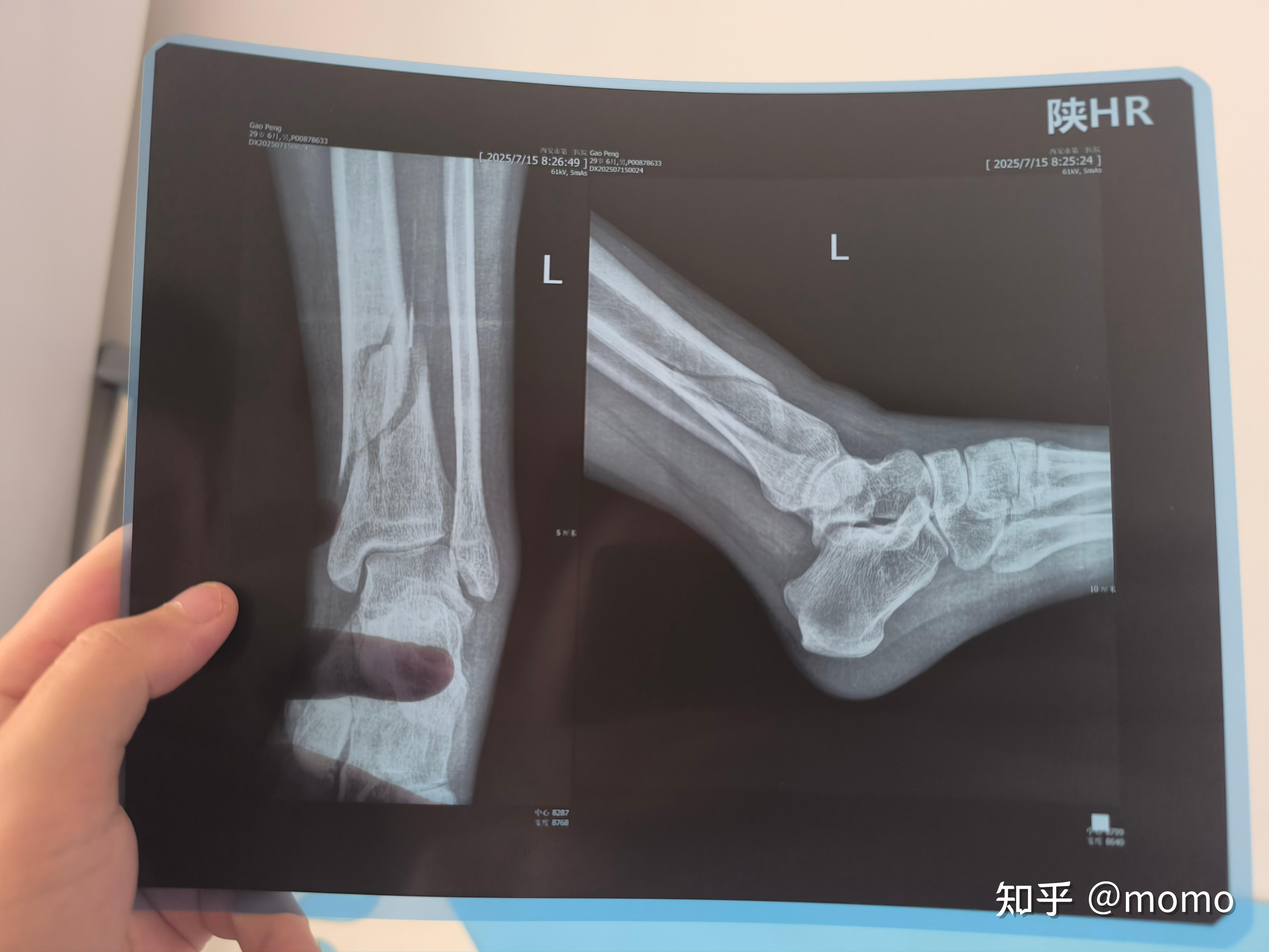 到了外侧,骑车去最近的西安市三院挂了急诊,拍ct后发现戒烟爱好者momo