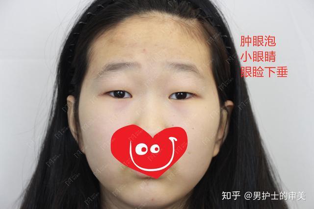 从照片可以看出,她的眼睛主要存在:1,眼睛短,小;2,肿眼泡明显;3,眼睛