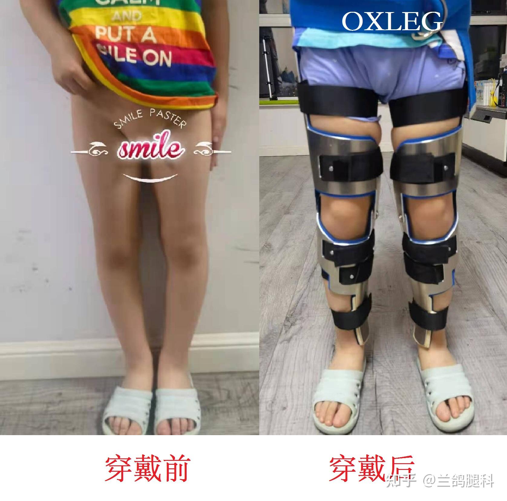 o型腿怎么矫正手术费用大概需要多少