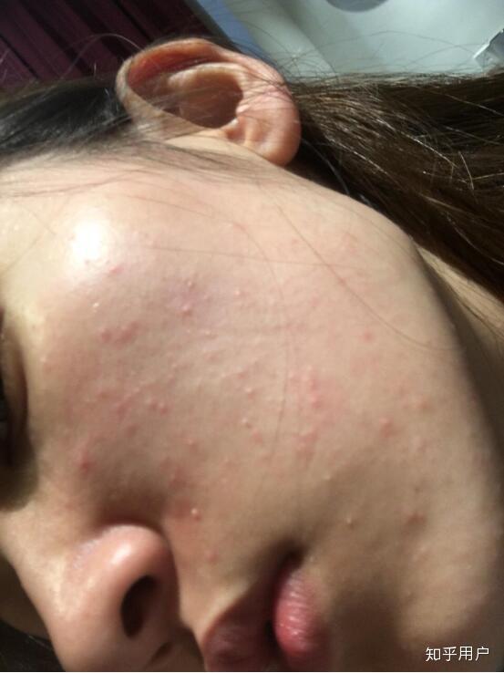 脸上密密麻麻的小颗粒突起,主要是鼻子两侧,请问是闭合性粉刺么?