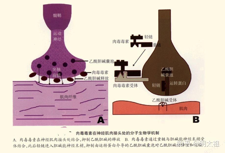 肉毒素可作用於周圍運動神經末梢,即神經突觸,抑制突觸前膜釋放乙酰