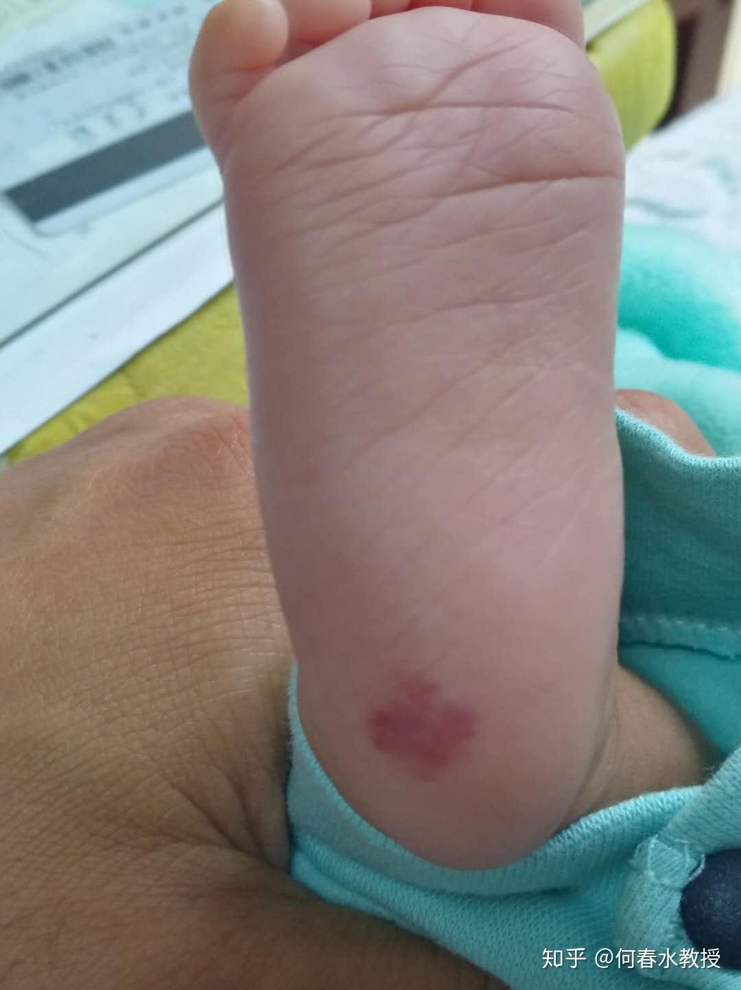 普萘洛尔治疗血管瘤不良反应及注意事项