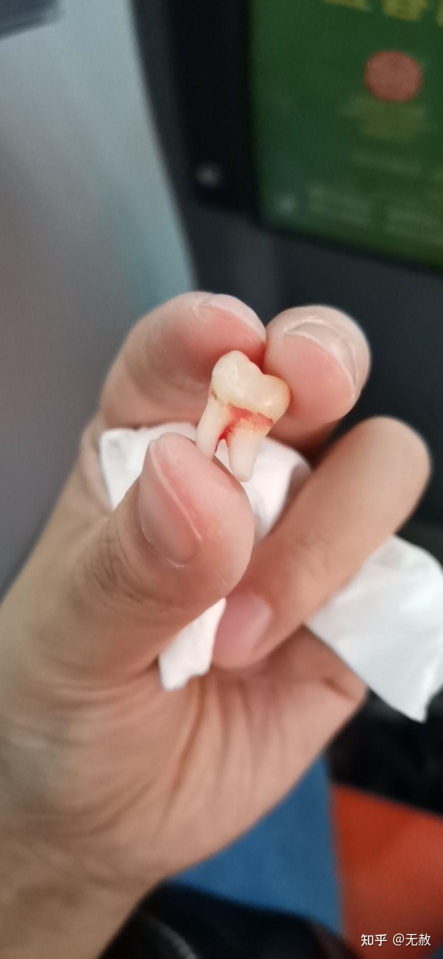 拔完智齿的前三天大家都是怎么熬过来的