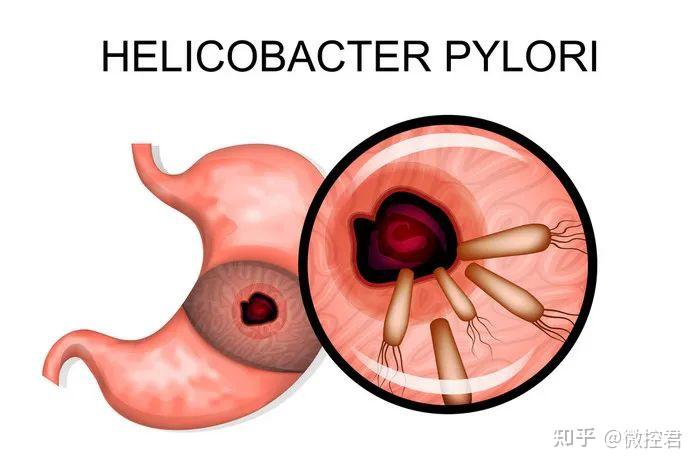 揭秘幽门螺旋杆菌