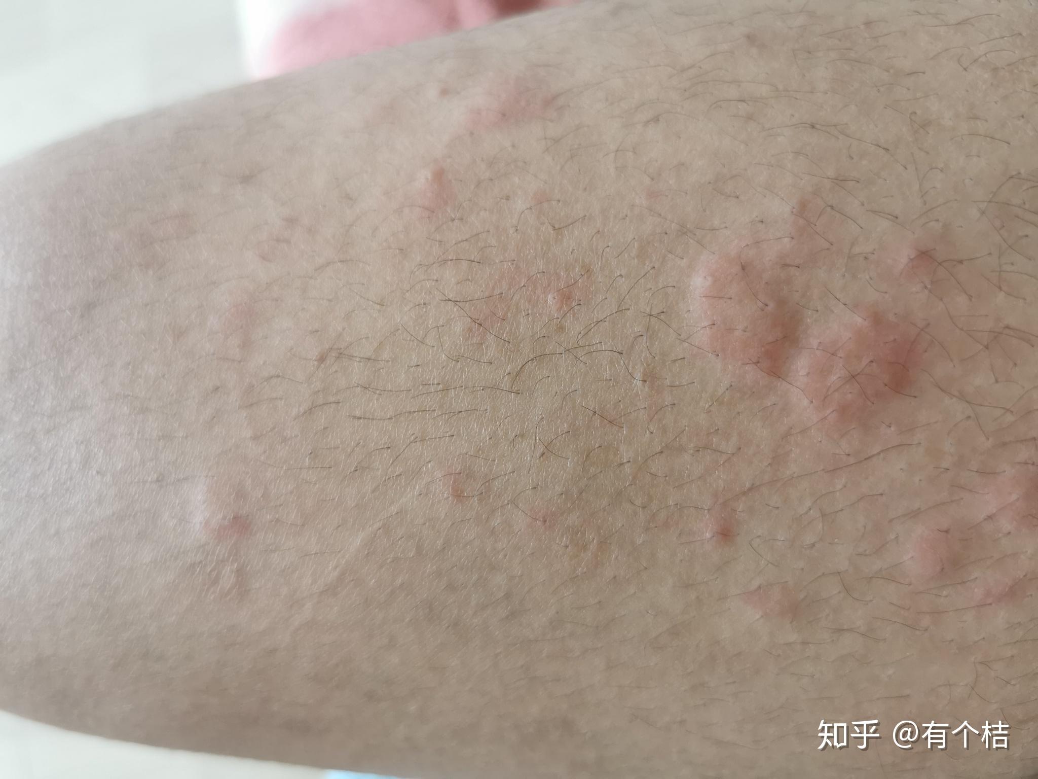 荨麻疹 - 知乎