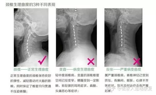 不做低头族 跟颈椎病say Byebye 知乎