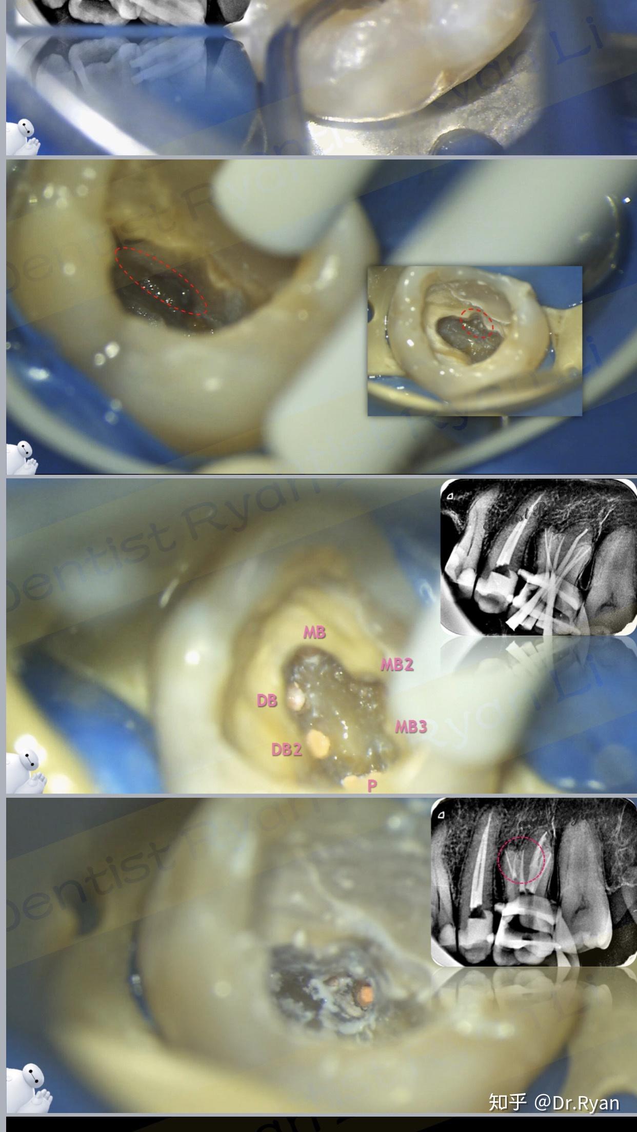 为什么牙根数量是一二三根,但是一般广告或者图片上都是四个牙根?