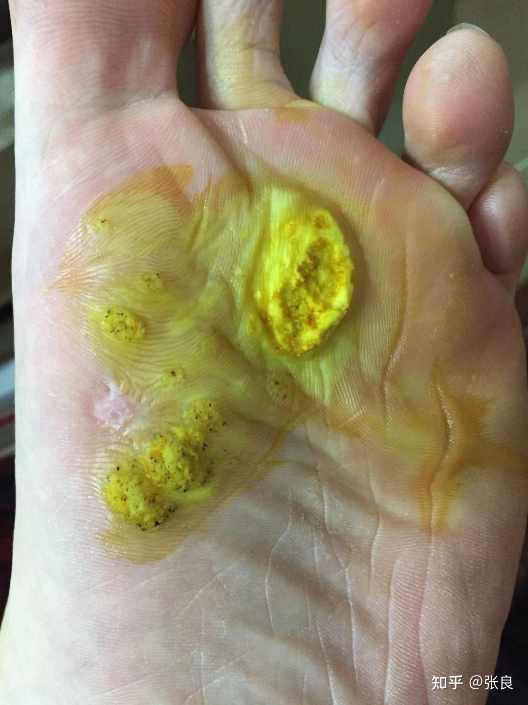 严重跖疣怎么治疗?(持续更新……)