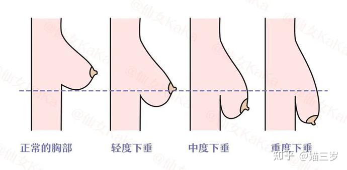 正常乳房的形态及位置图片
