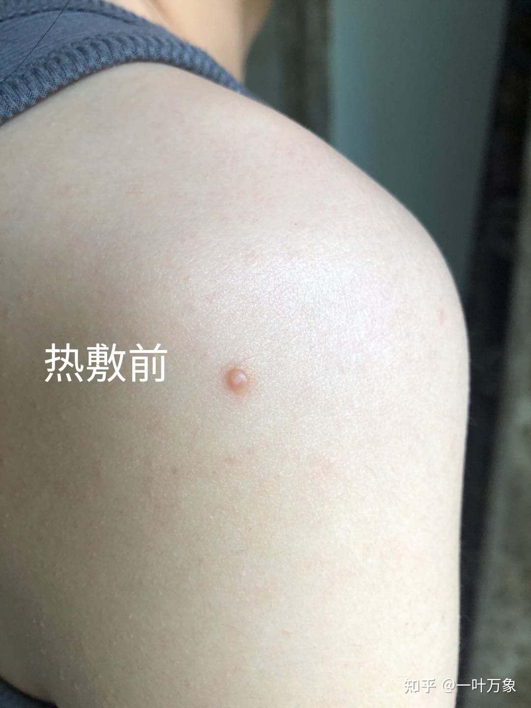 传染性软疣家长必知的温和处理方案