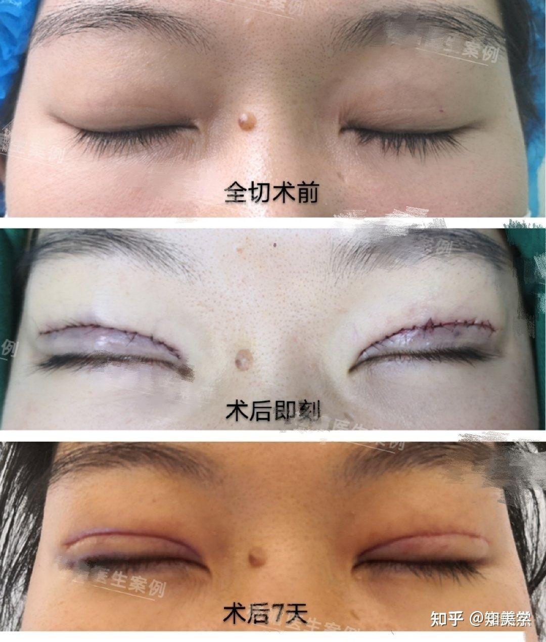 两条疤的不成型双眼皮修复 - 周兆平整形网
