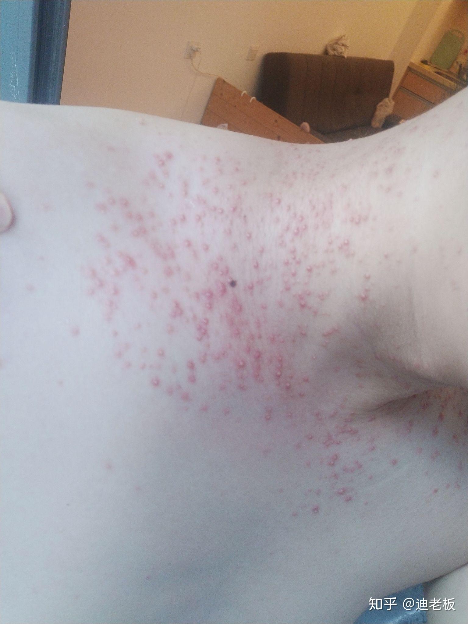 为什么涂身体乳身上长了疙瘩(为什么涂身体乳身上长了疙瘩很痒)