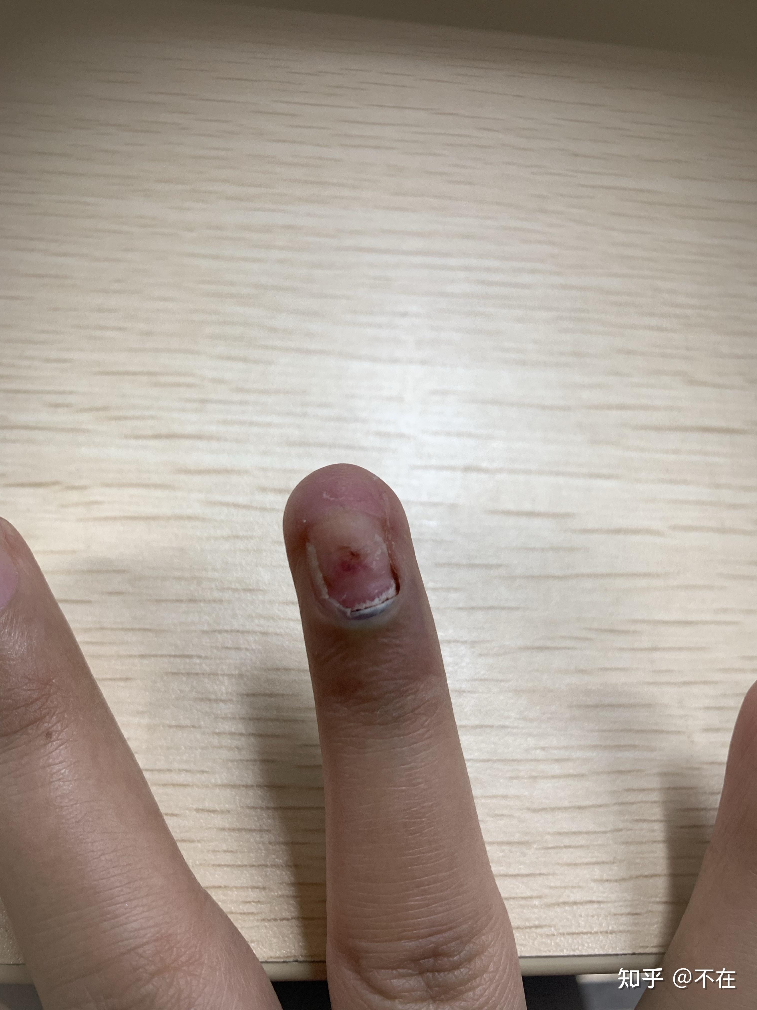 手指甲被夹到,过了一段时间,有黑色的淤血,怎么处理? - 知乎