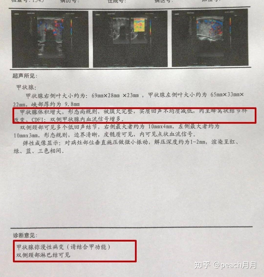 体检中发现患有桥本氏甲状腺炎该怎么办