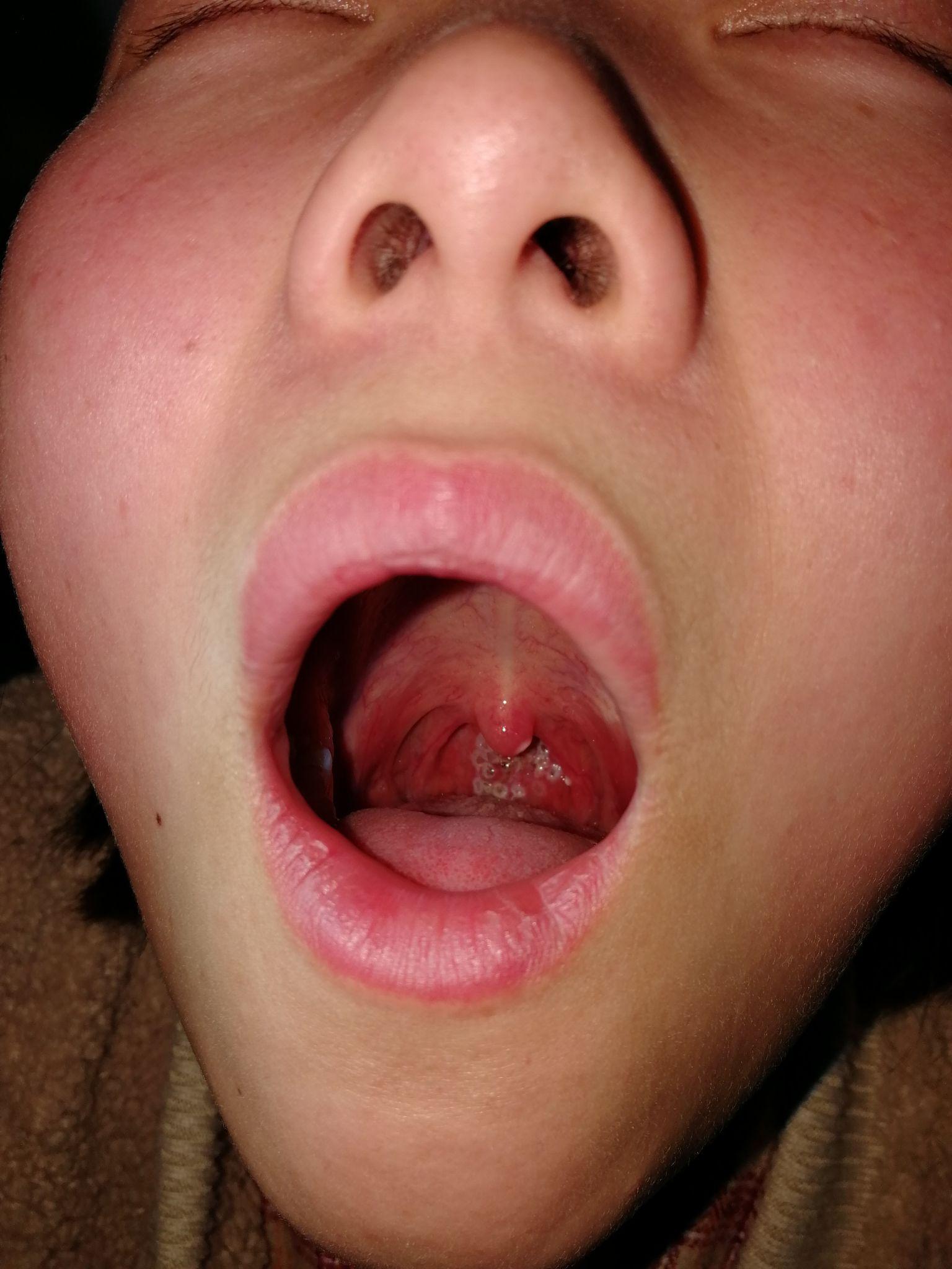 有谁做过等离子消融手术去治疗慢性咽炎么?请问效果如何?