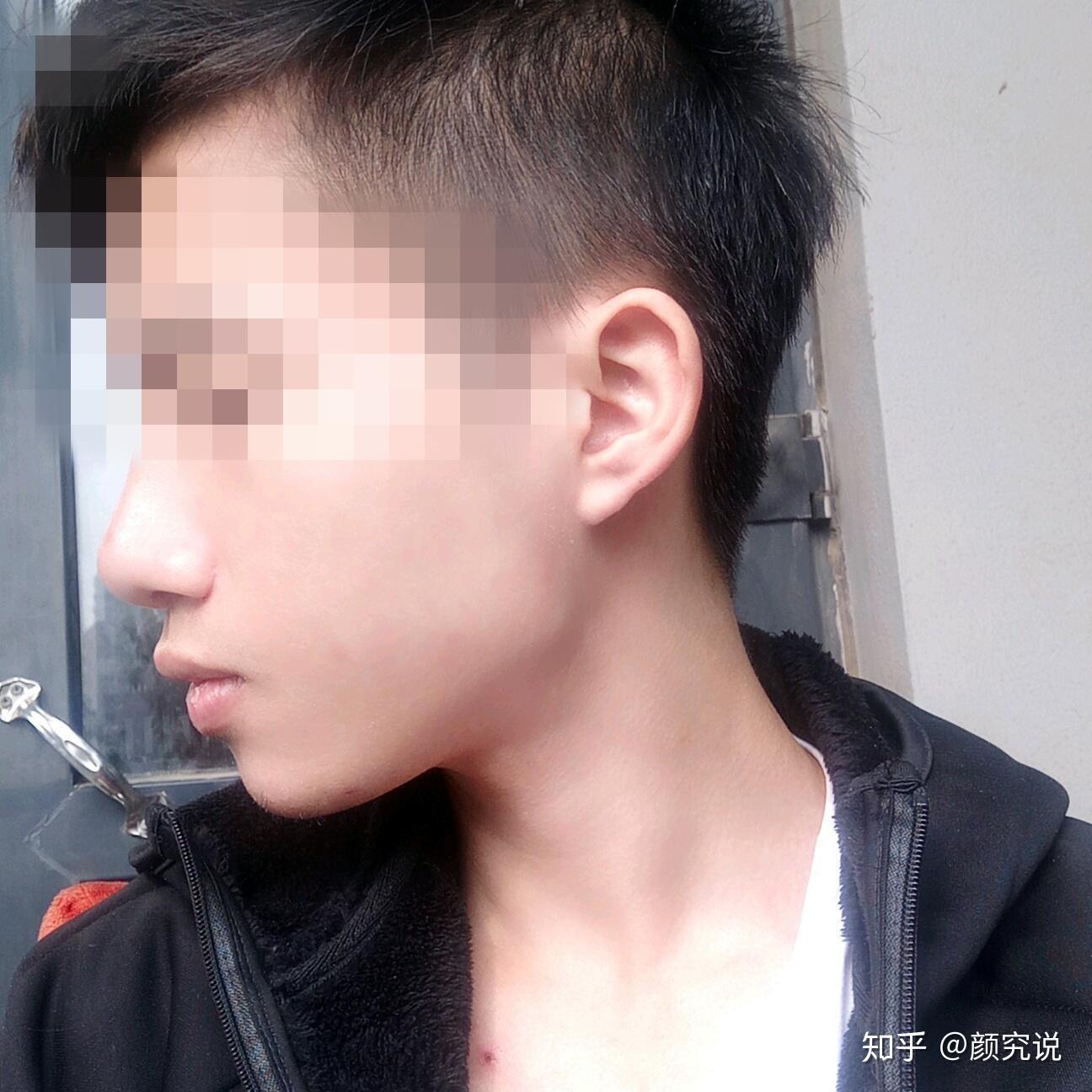 正面看很正常,侧面没下巴是什么体验? - 知乎