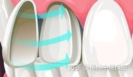 什么人不适合做牙贴面 v2-f811fc7b74b4fe11a42c2cf767621850_b.jpg