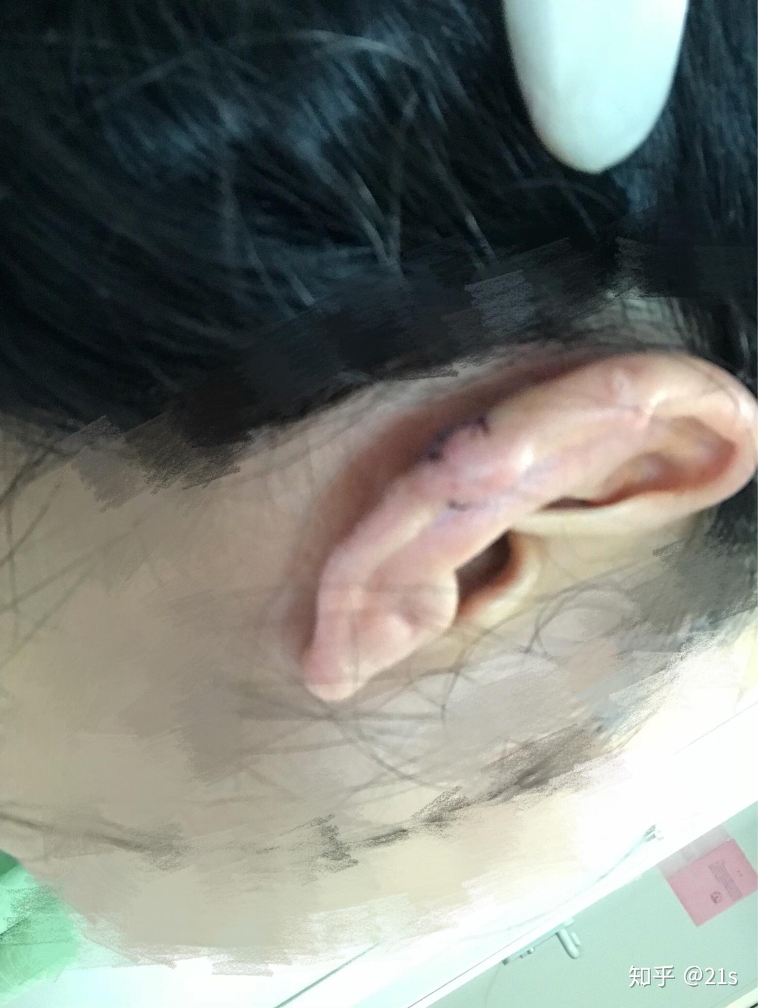 瘢痕疙瘩怎么去除