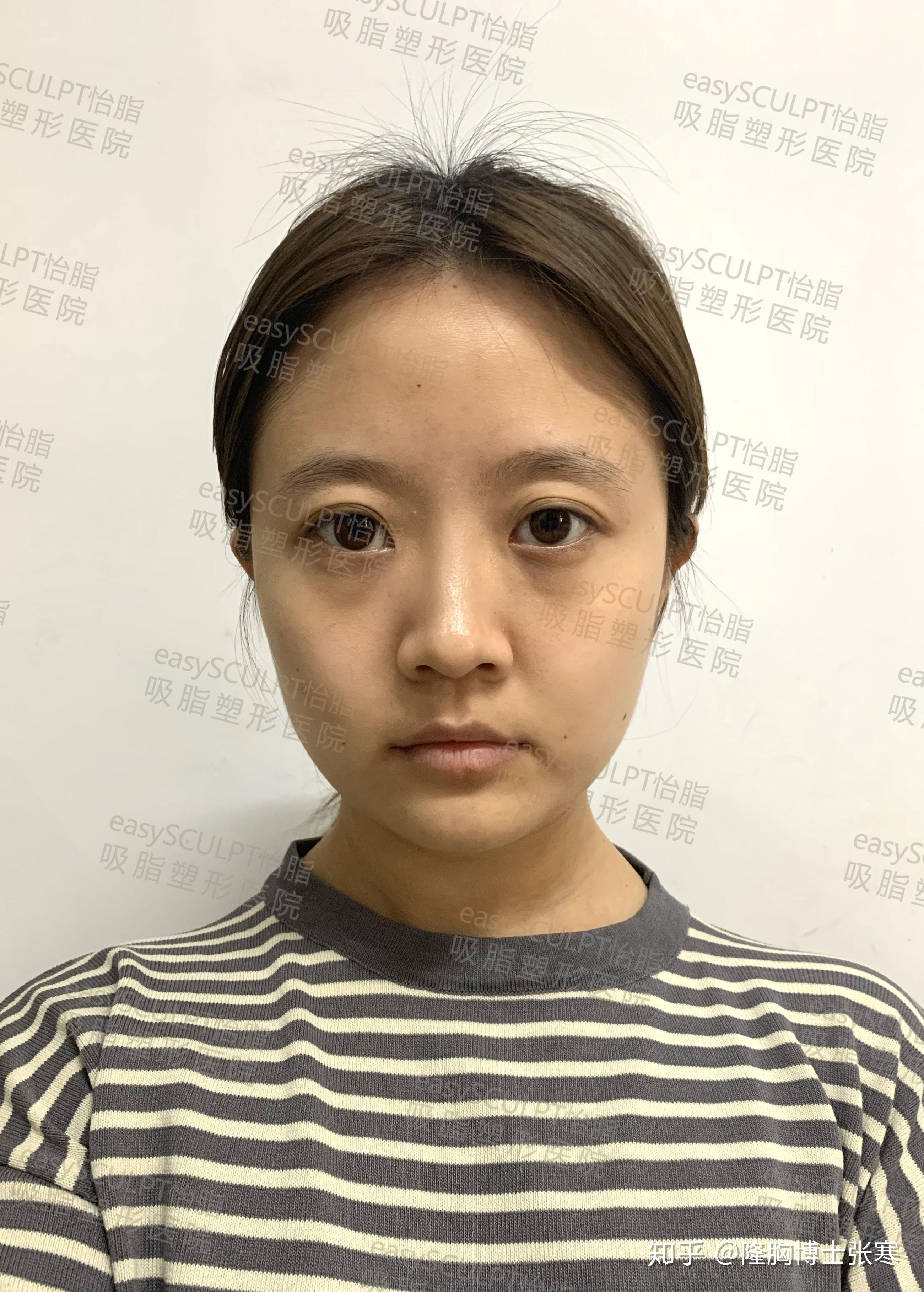 蛋白填充脸部能保持多久_蛋白填充脸会硬吗_自体胶原蛋白填充面部能维持多久