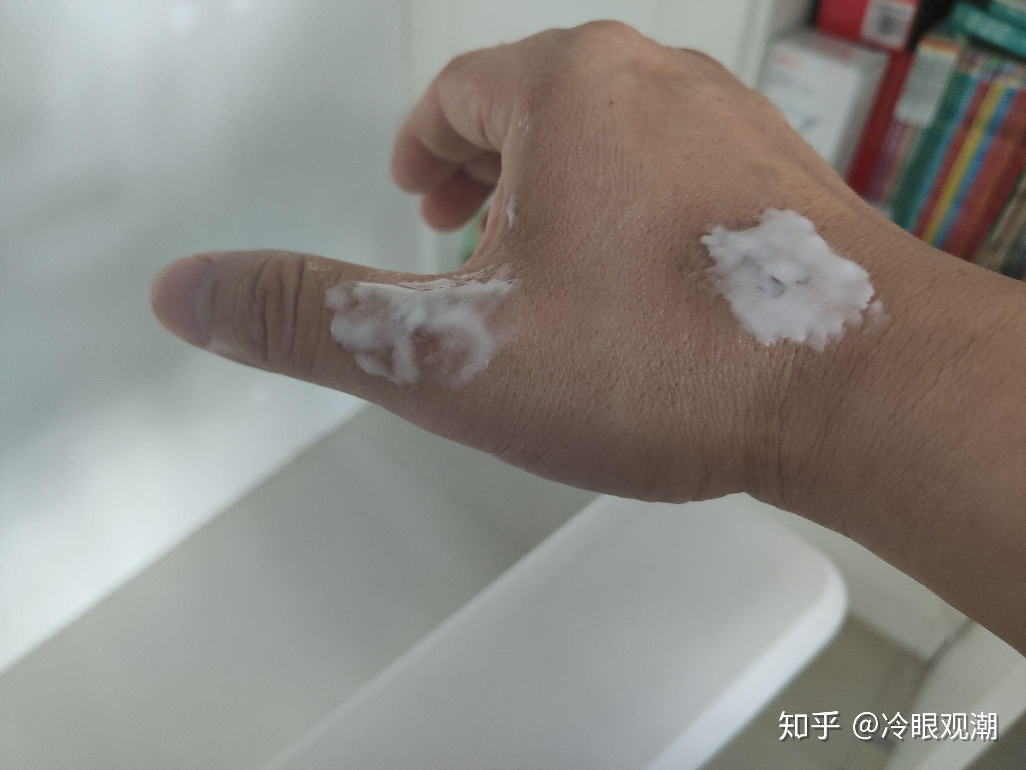 手烫伤了怎么办,起泡了? - 知乎