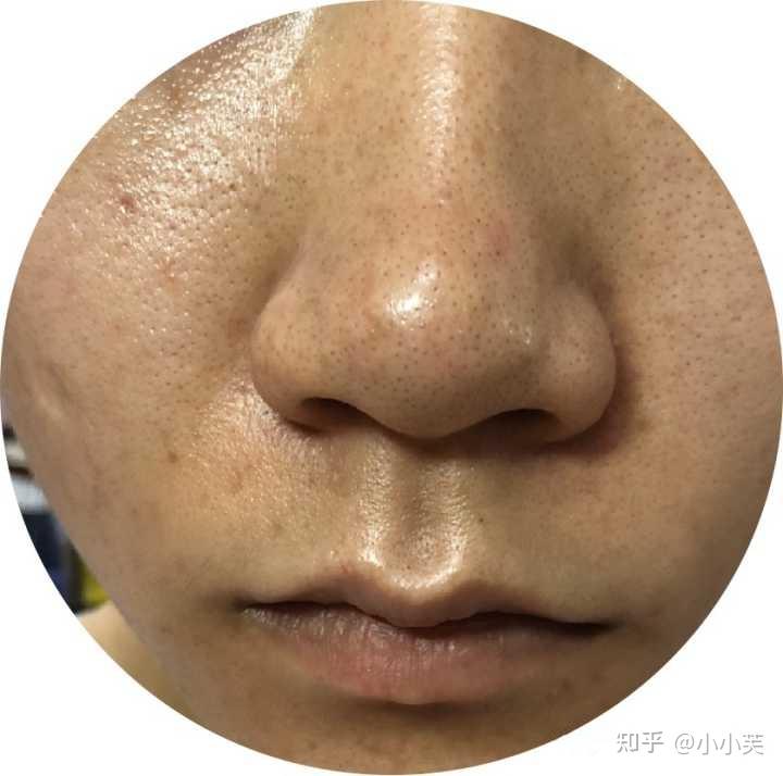 油皮毛孔粗大的人该如何控油护肤?
